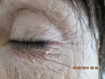 DERMAPEN MICRONEEDLING