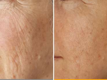 Skin rejuvenation