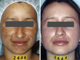 Pigmentation and Melasma