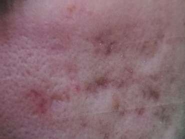 Subcision of acne Scars